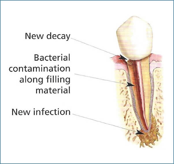 tooth model