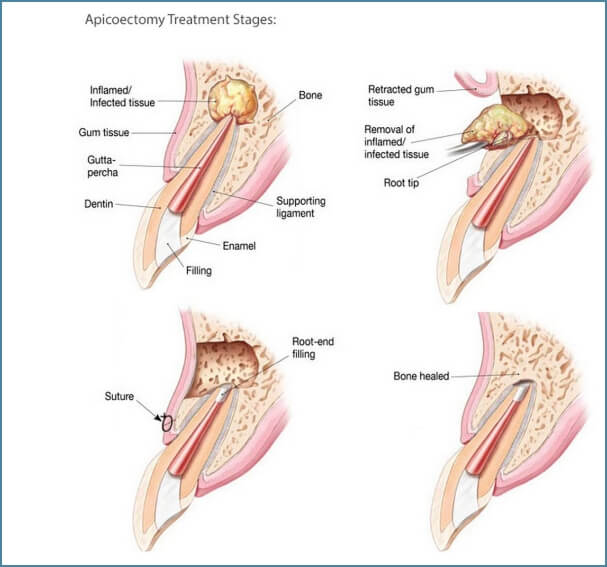 tooth model