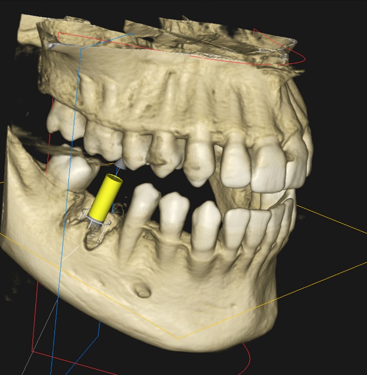 a model showing the enhanced CBCT scanner