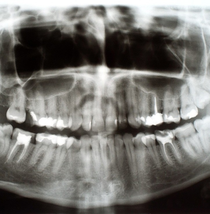 an xray of smile