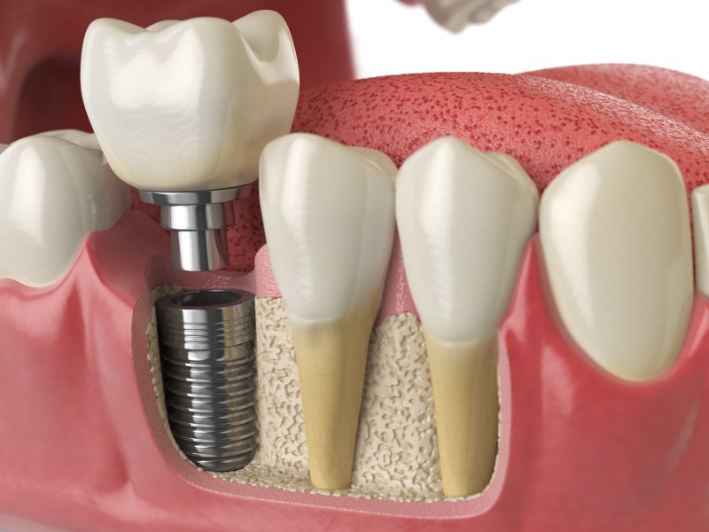 Illustration of dental implant in Reno